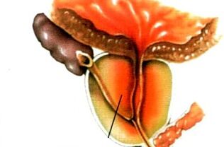 Erkeklerde prostatit nedir