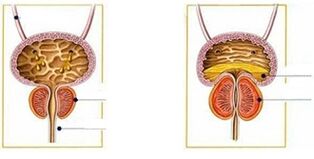 Erkeklerde prostatit türleri ve biçimleri