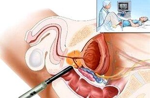 Prostatit teşhis etmenin yolları