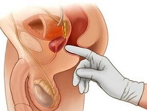 Erkeklerde prostatit tedavisi için prostat masajı