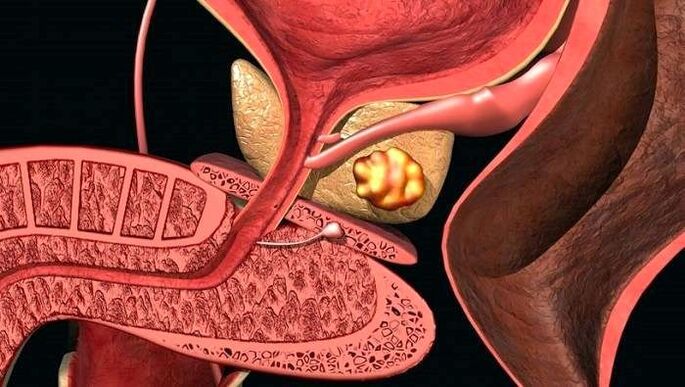 Taşlı prostatit ile prostatta taş birikintileri