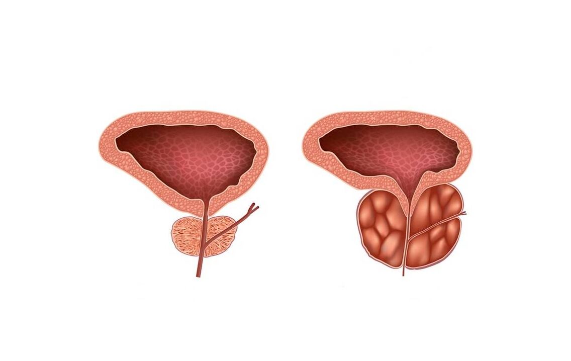 erkeklerde prostatit belirtileri
