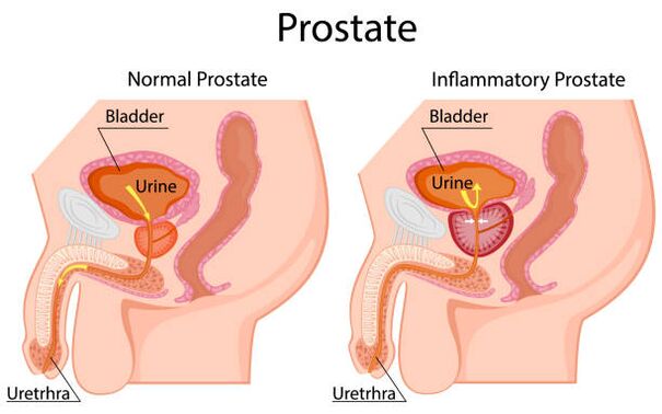 sağlıklı ve iltihaplı prostat
