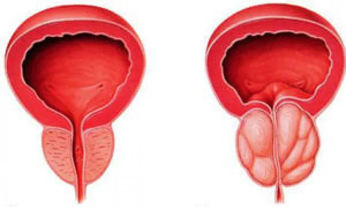 Normal prostat (solda) ve iltihaplı kronik prostatit (sağda)
